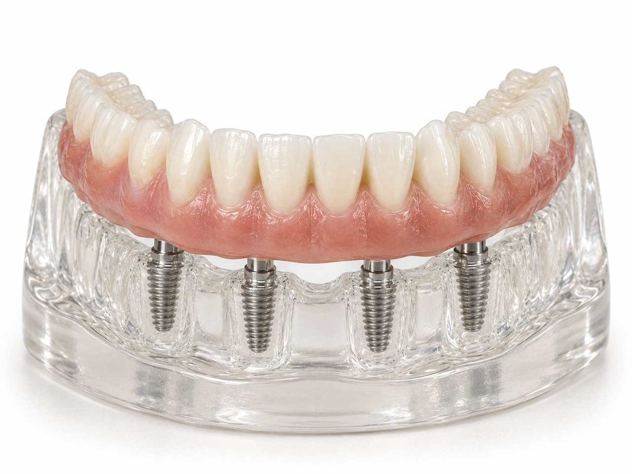 Verschraubte Brücke auf Implantaten