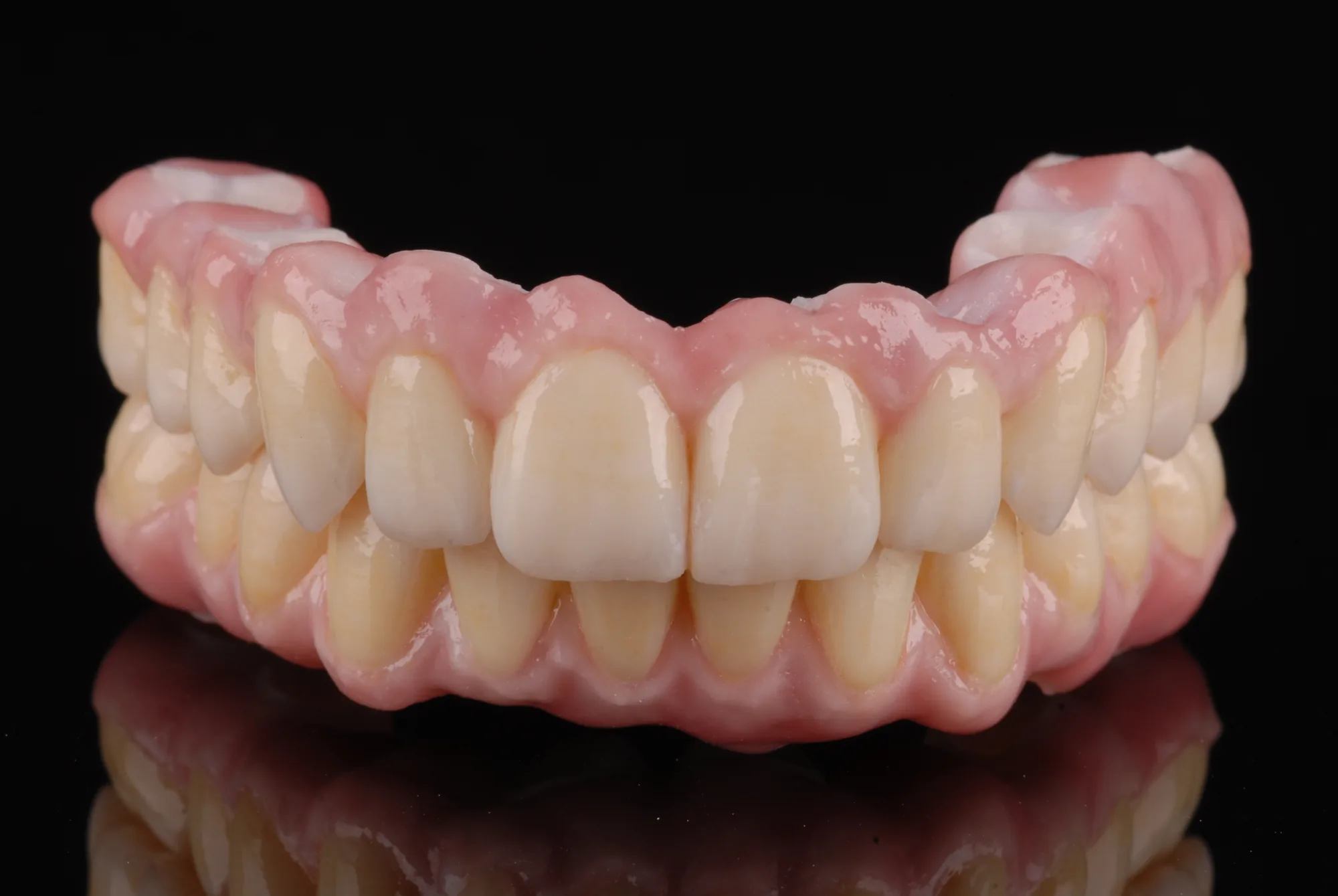 Monolithische Zirkonarbeit für Ober- und Unterkiefer auf jeweils sechs individuellen Abutments von ADU-Dental