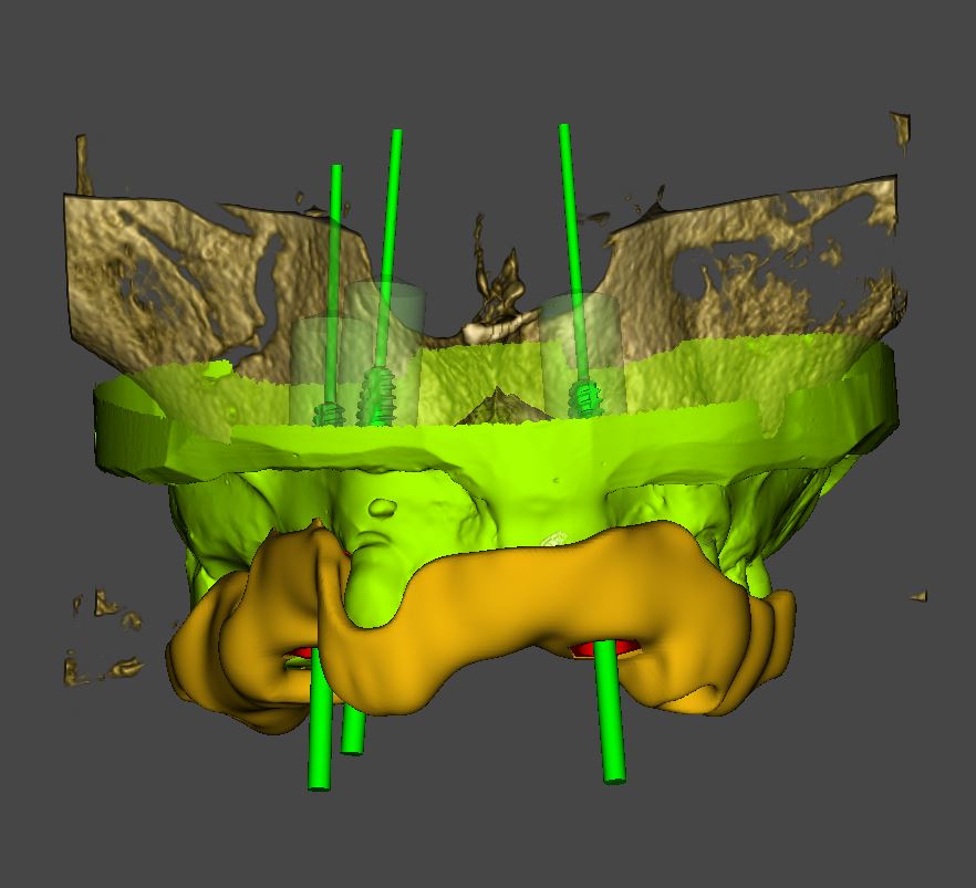 Digitale Planung der Implantatpositionen bei ADU-Dental