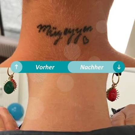 Schriftzug im Nacken vor und nach der Laserentfernung