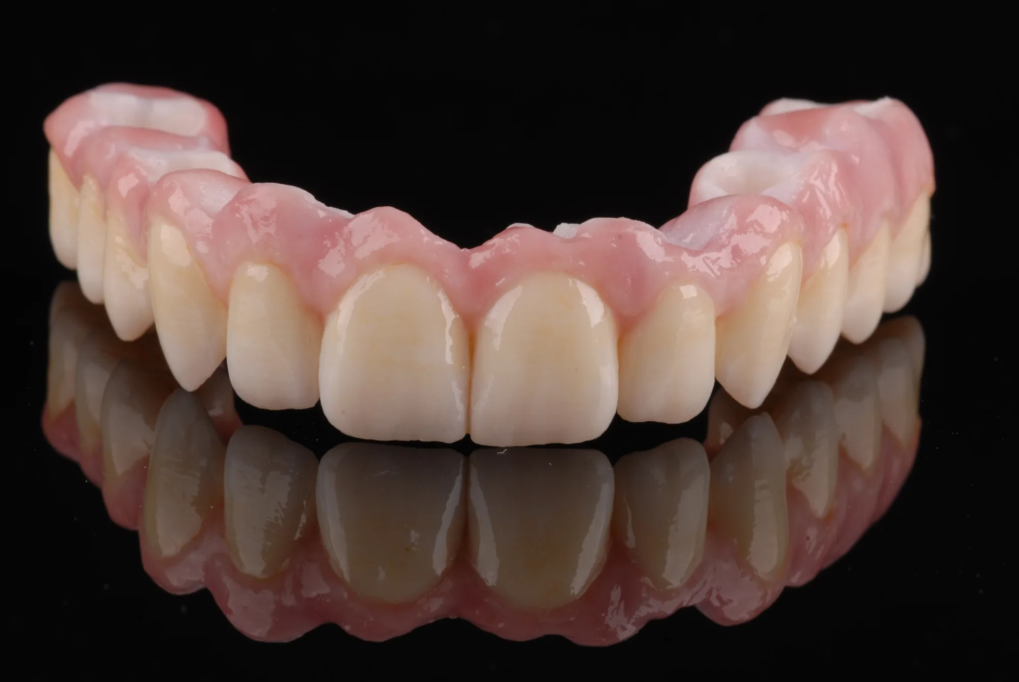 Implantatgetragene Oberkieferversorgung aus dem Dentallabor ADU-Dental in Göggingen