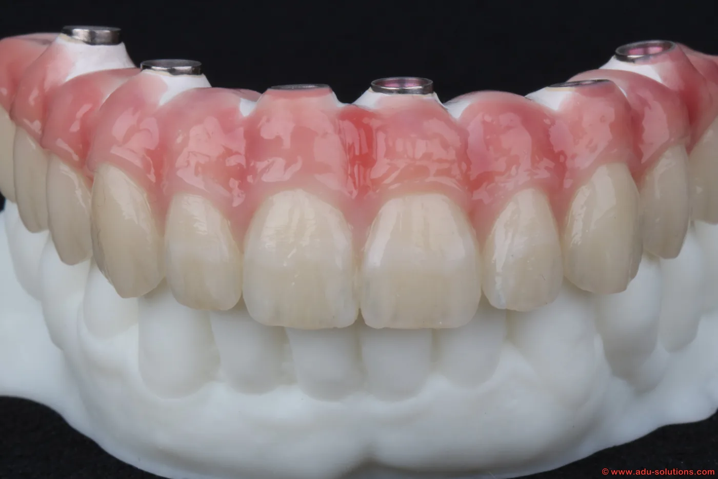 Verschraubte implantatgetragene Vollversorgung des Oberkiefers aus dem Dentallabor ADU-Dental