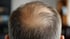 Bald Crown 