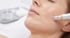 Nahaufnahme einer Microneedling-Behandlung im Gesicht einer Frau zur Hautverjüngung.