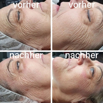 Vorher-Nachher Hautergebnis