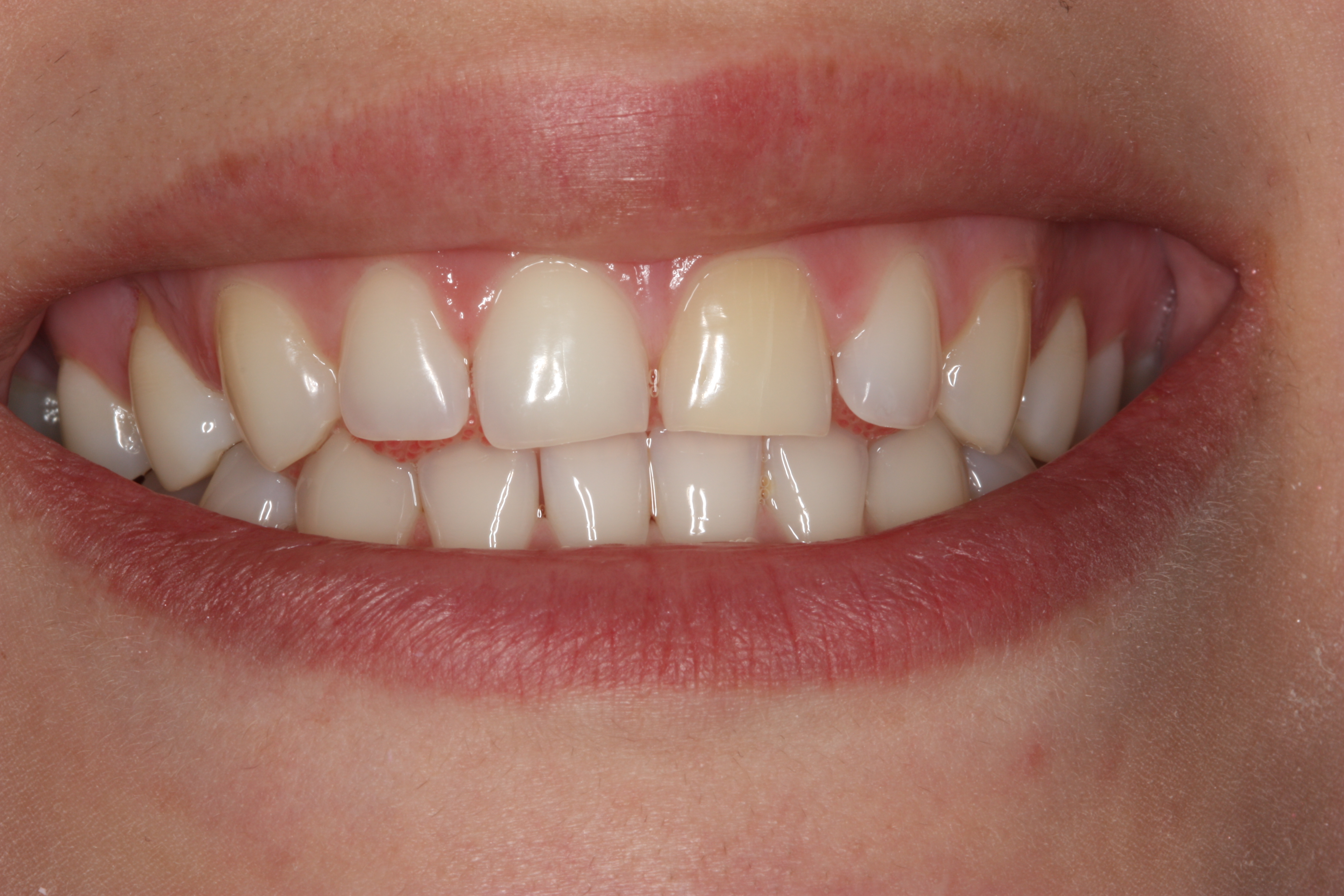 Veneers – Vorher