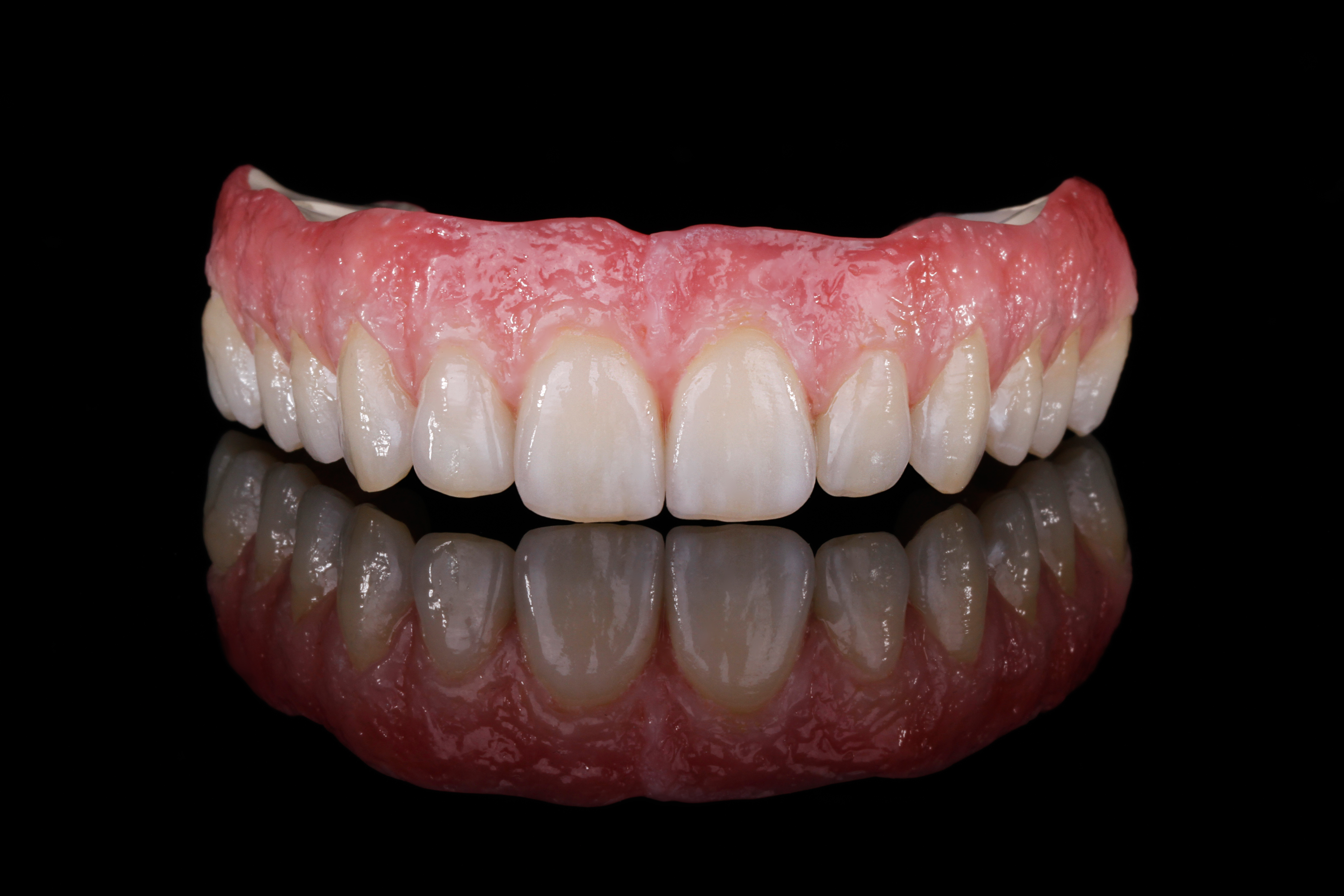 Implantatgetragene Zirkon-Teleskoparbeit für den Oberkiefer, CAD/CAM-gefräst von ADU-Dental
