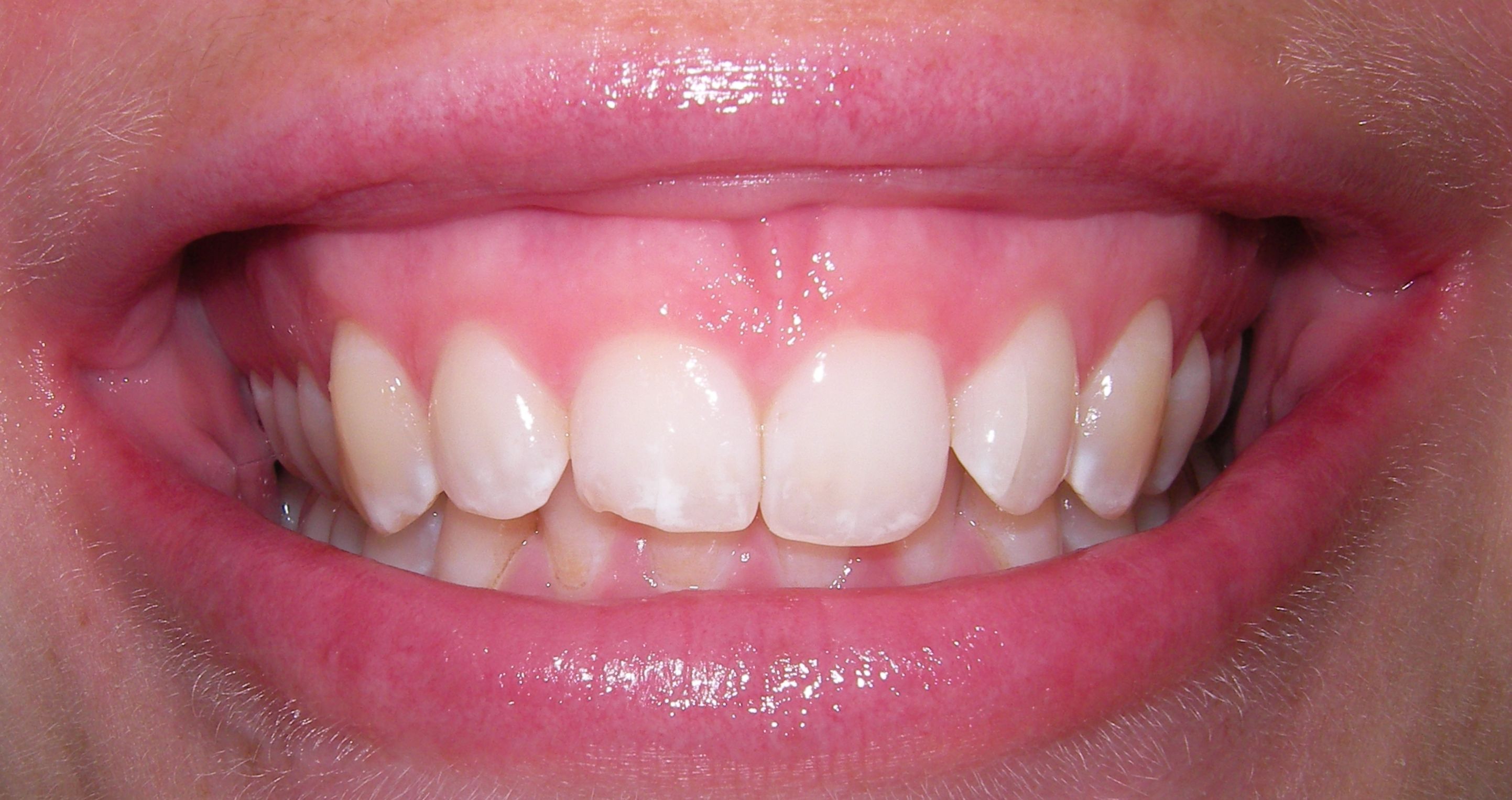 Kronenverlängerung und vier Veneers – Vorher