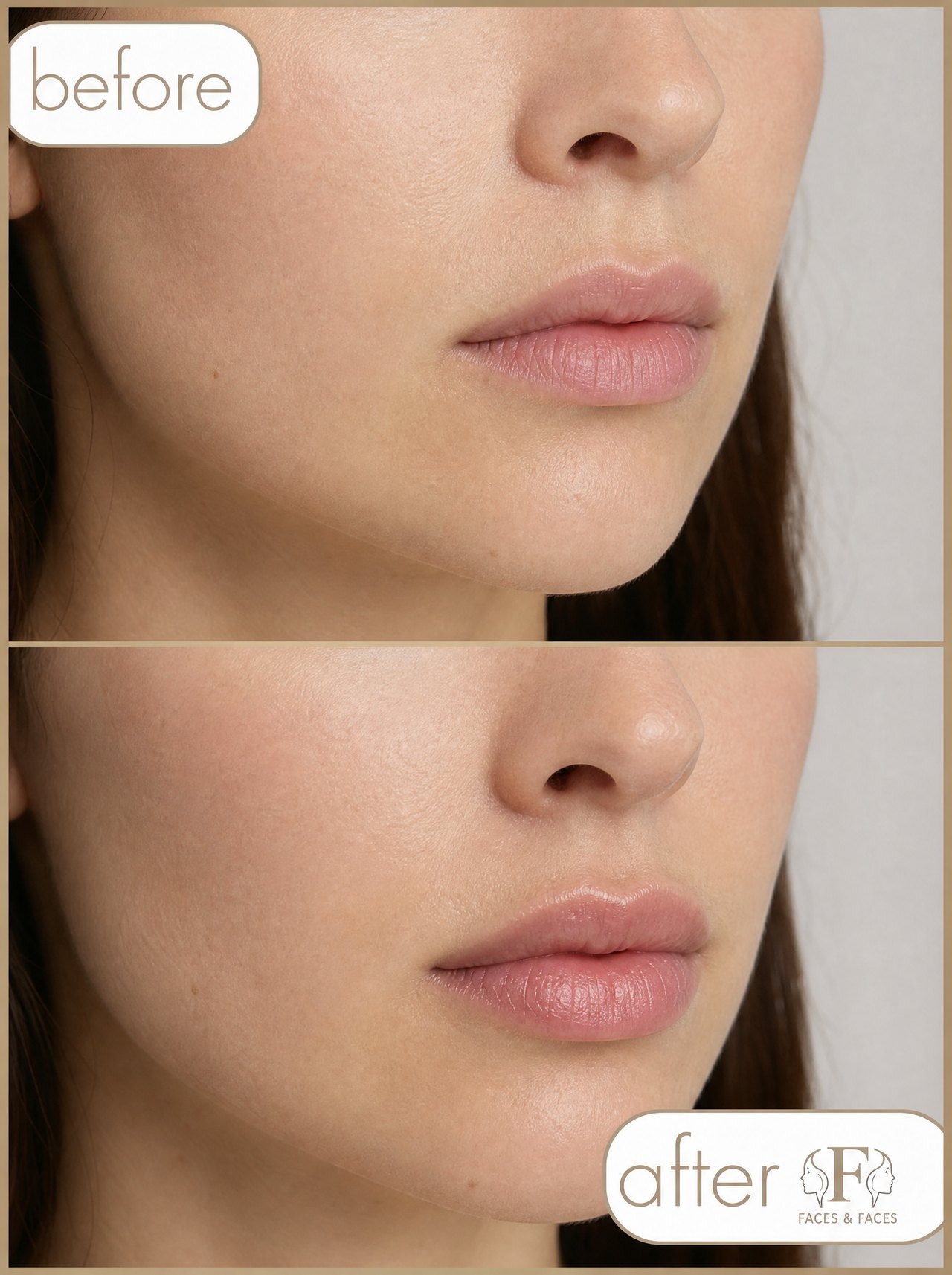 Lippen vorher und nachher