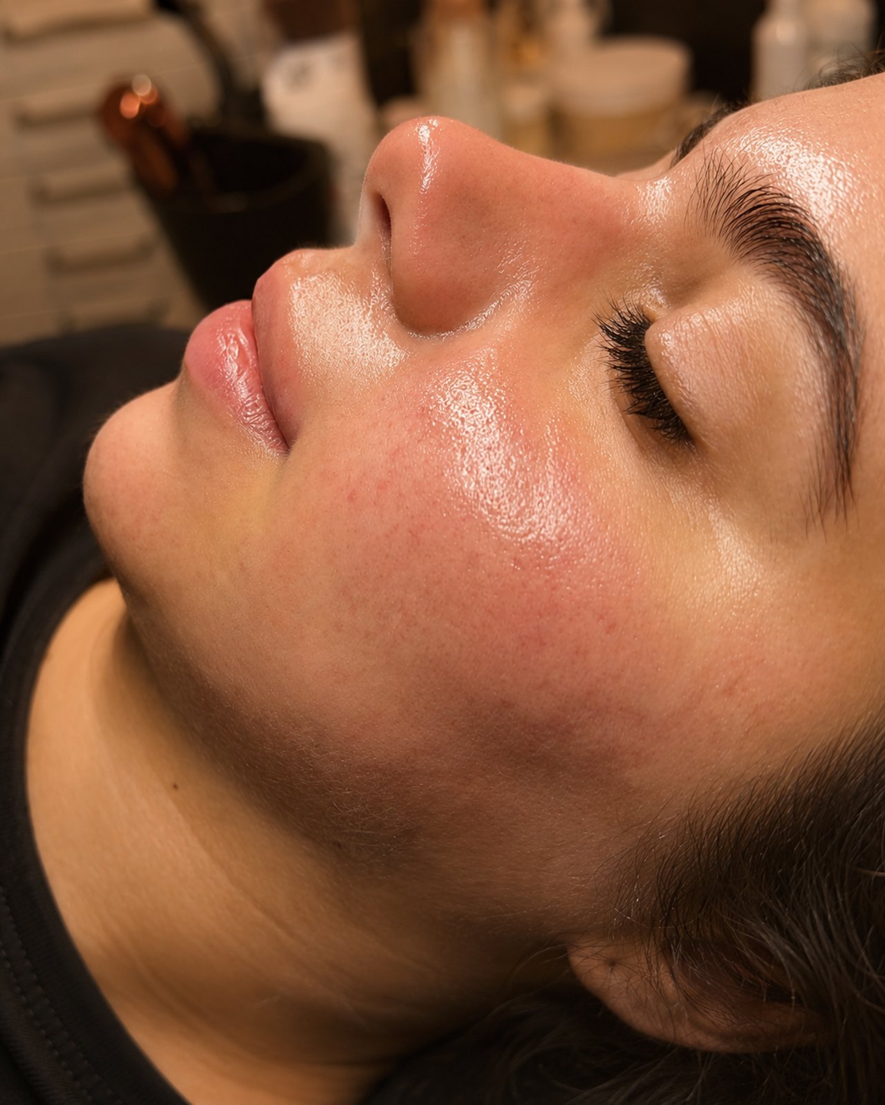 Behandlungsergebnis nach Microneedling bei SWON in Pforzheim, Aufnahme 2