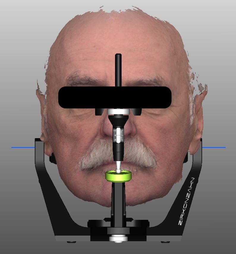 3D-Gesichtserfassung eines Patienten im virtuellen Artikulator bei ADU-Dental