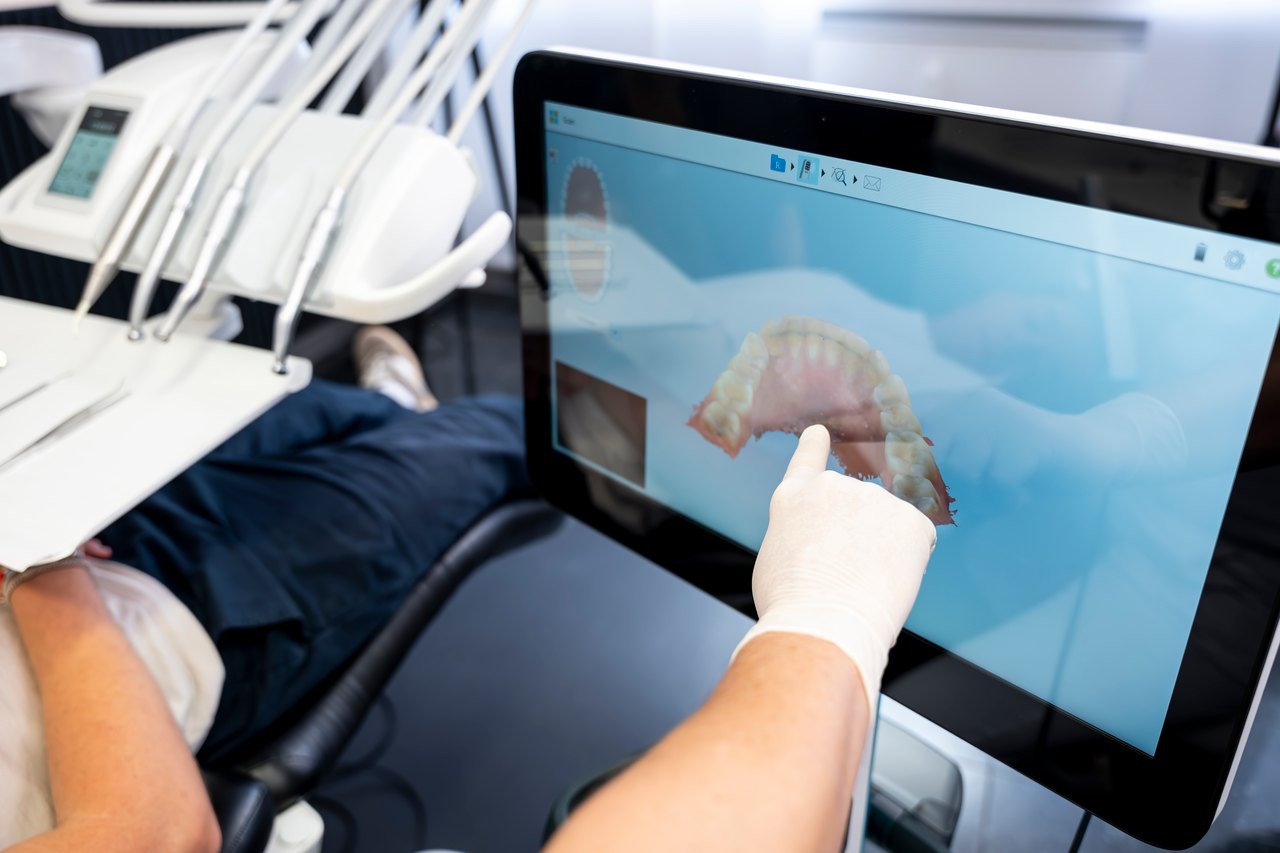 3D-Scan mit dem iTero-Scanner