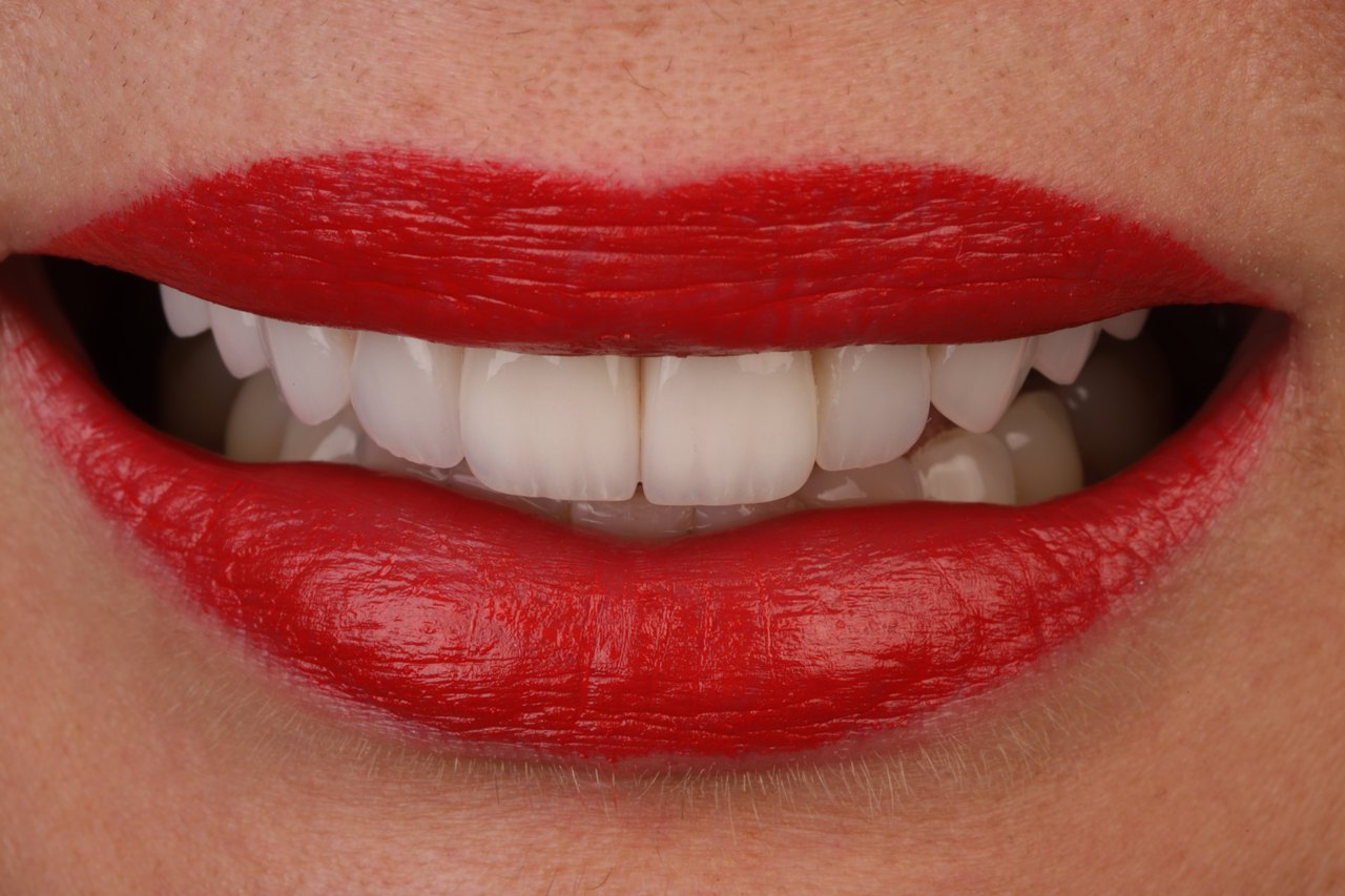 Dentalfoto: Frontzähne