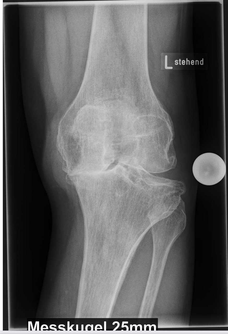 Röntgenbild – das zerstörte Knie
