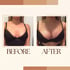 Before and after breast augmentation comparison of a woman wearing a black bra.