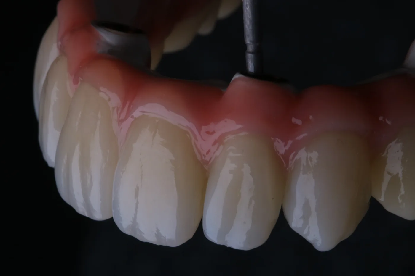 Titan-Teleskoparbeit von ADU-Dental