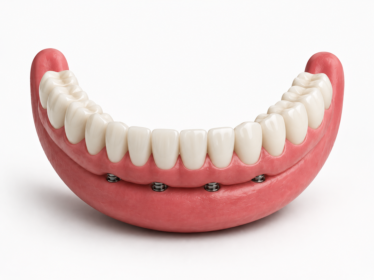 Feste Brücke auf den Implantaten