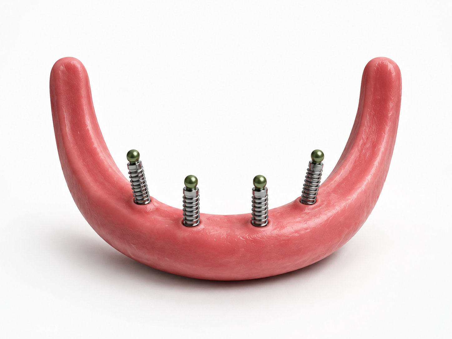 Vier gesetzte Implantate