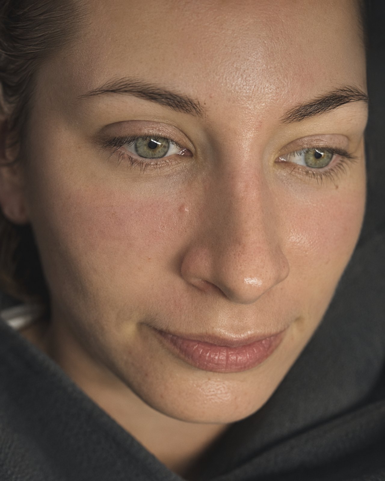 Behandlungsergebnis nach Microneedling bei SWON in Pforzheim, Aufnahme 1