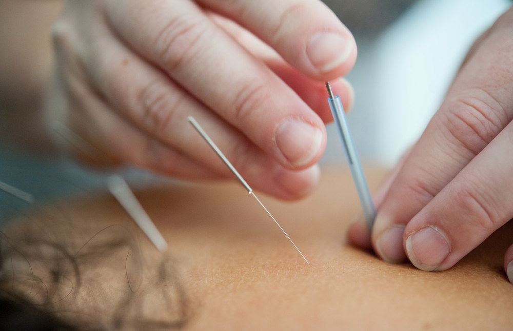 Physiotherapeutische Akupunktur zur Unterstützung der Schmerzlinderung und Regulation